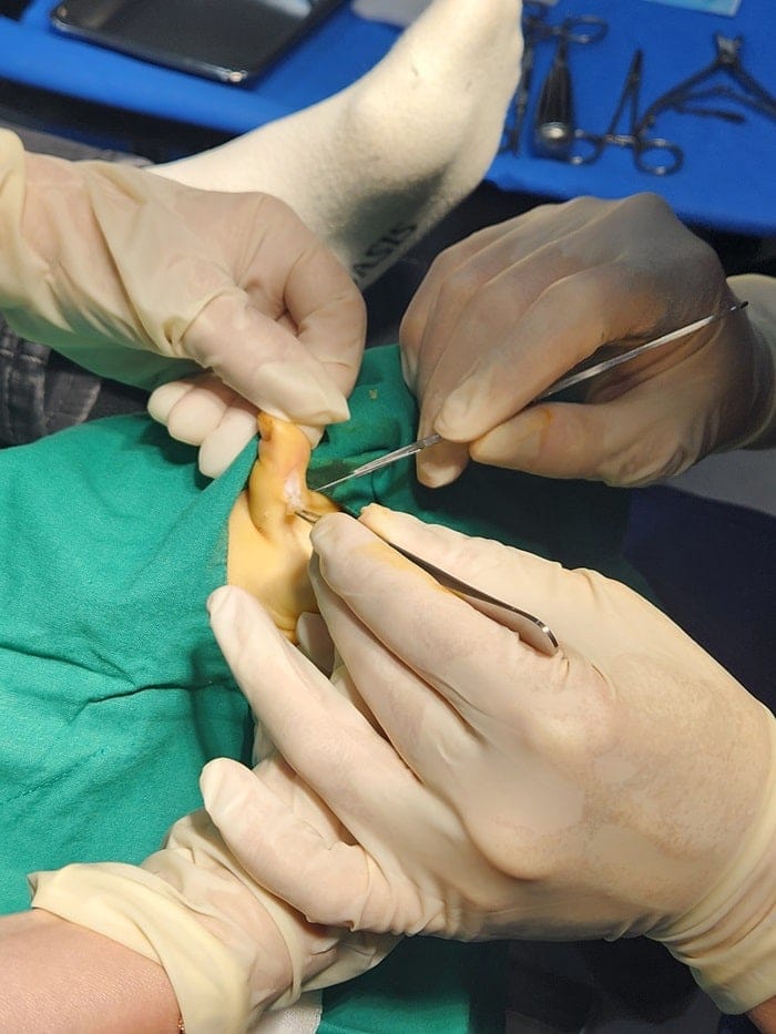 Toe Blisters, Corns & Calluses Treated by a Foot Specialist at Gangnam Standard Orthopedic Clinic — 5