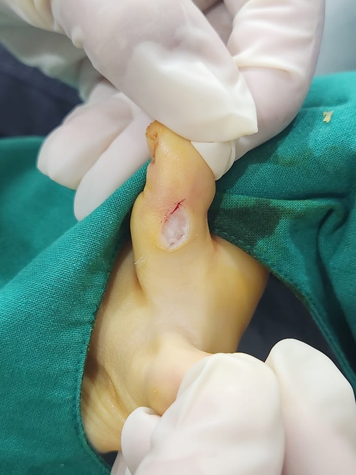 Toe Blisters, Corns & Calluses Treated by a Foot Specialist at Gangnam Standard Orthopedic Clinic — 6