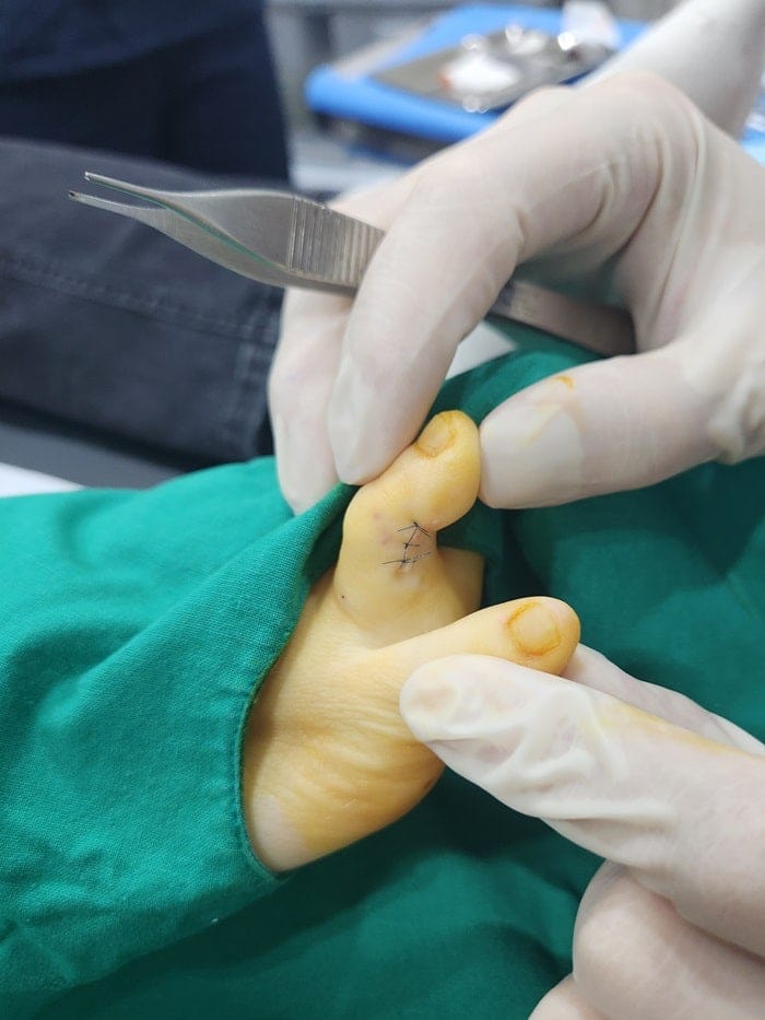 Toe Blisters, Corns & Calluses Treated by a Foot Specialist at Gangnam Standard Orthopedic Clinic — 8