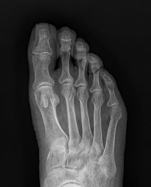 Ingrown Toenail Self-Treatment vs. Specialist Care: Why Accurate Diagnosis Matters for Toe Pain Relief — 2