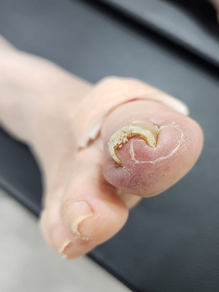 Ingrown Toenail Self-Treatment vs. Specialist Care: Why Accurate Diagnosis Matters for Toe Pain Relief — 4