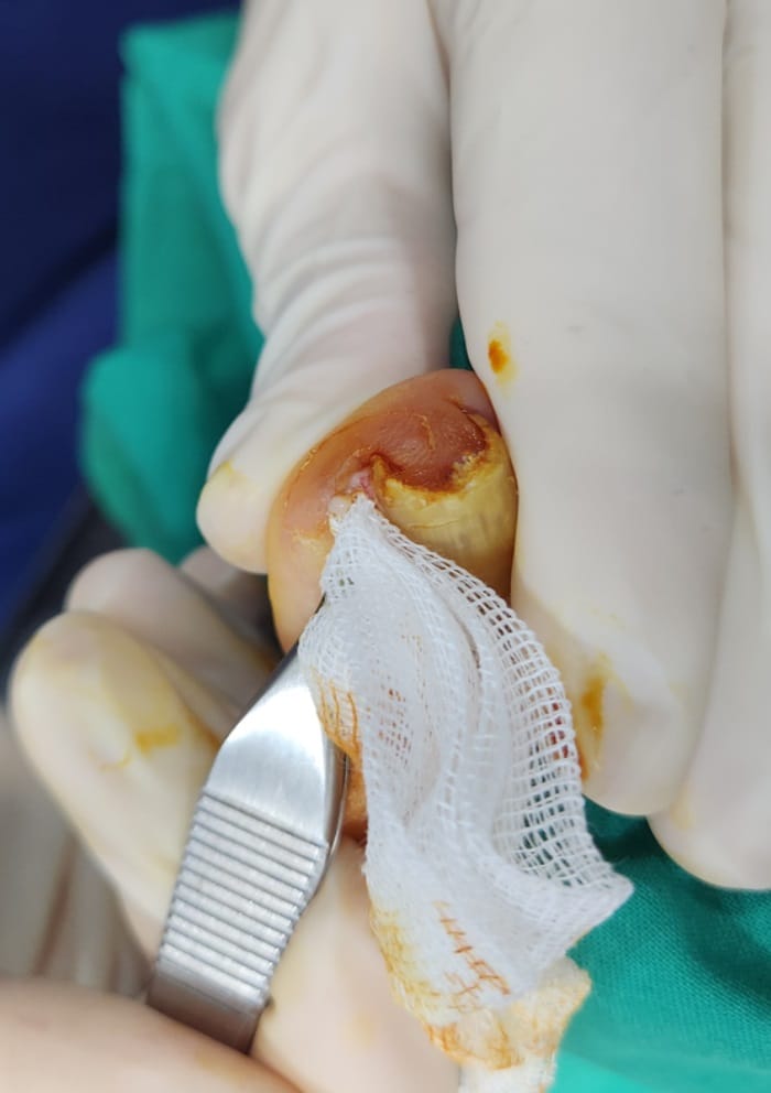 Ingrown Toenail Self-Treatment vs. Specialist Care: Why Accurate Diagnosis Matters for Toe Pain Relief — 5