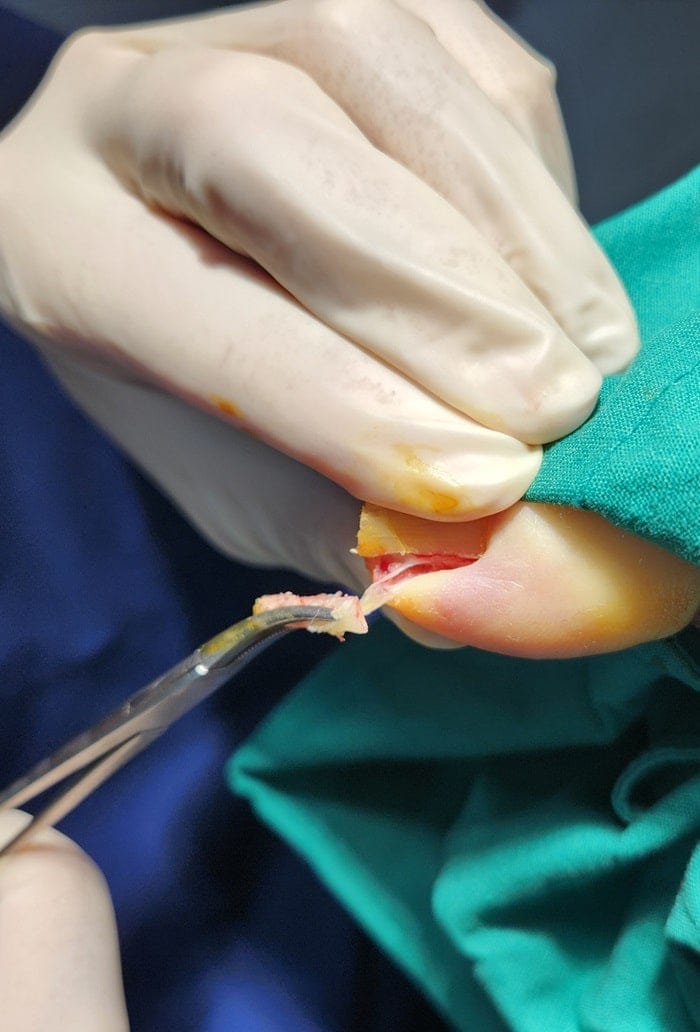 Ingrown Toenail Self-Treatment vs. Specialist Care: Why Accurate Diagnosis Matters for Toe Pain Relief — 6