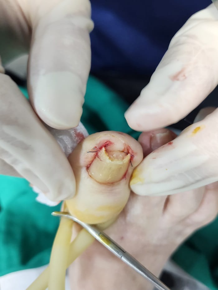 Ingrown Toenail Self-Treatment vs. Specialist Care: Why Accurate Diagnosis Matters for Toe Pain Relief — 7