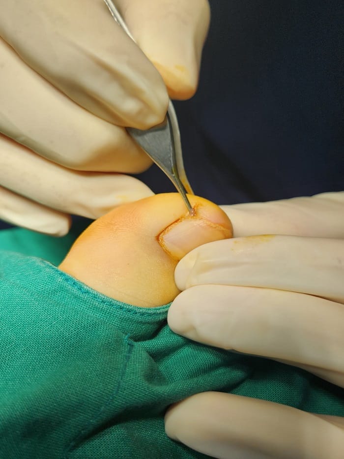 Ingrown Toenail in Children: Why Specialized Orthopedic Care Matters — 2