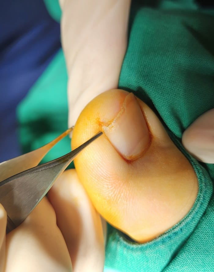 Ingrown Toenail in Children: Why Specialized Orthopedic Care Matters — 3