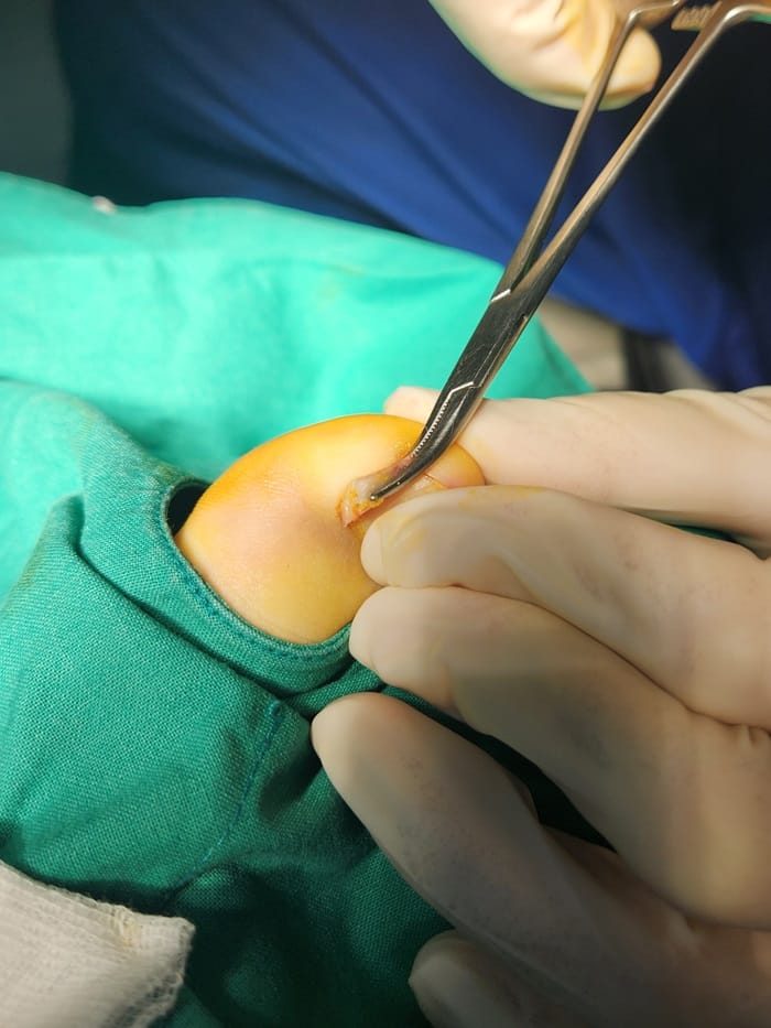 Ingrown Toenail in Children: Why Specialized Orthopedic Care Matters — 4