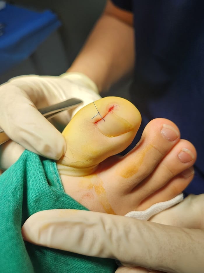 Ingrown Toenail in Children: Why Specialized Orthopedic Care Matters — 5