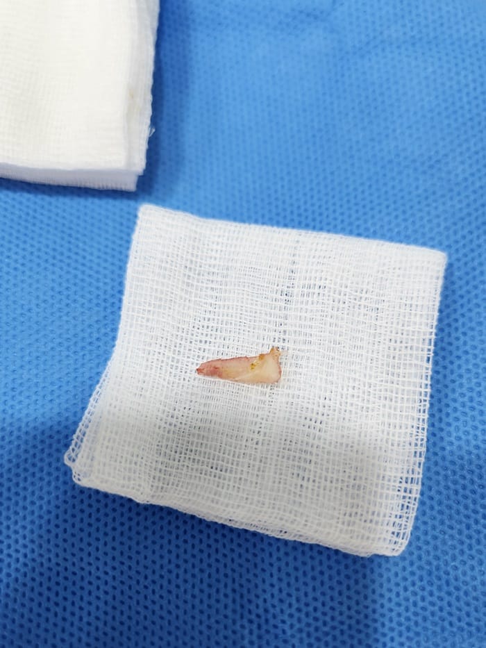 Ingrown Toenail in Children: Why Specialized Orthopedic Care Matters — 6