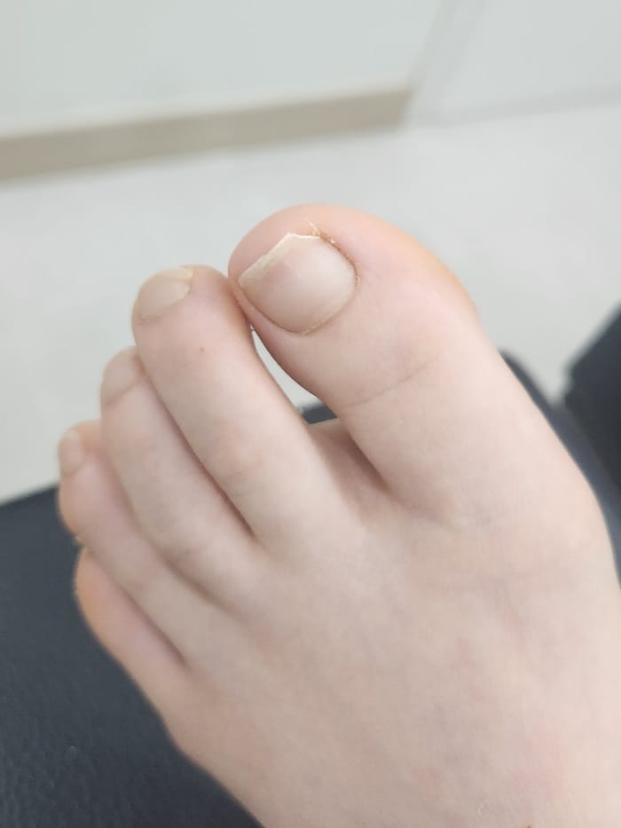 Ingrown Toenail Treatment for Children and Adolescents at Gangnam Standard Orthopedics