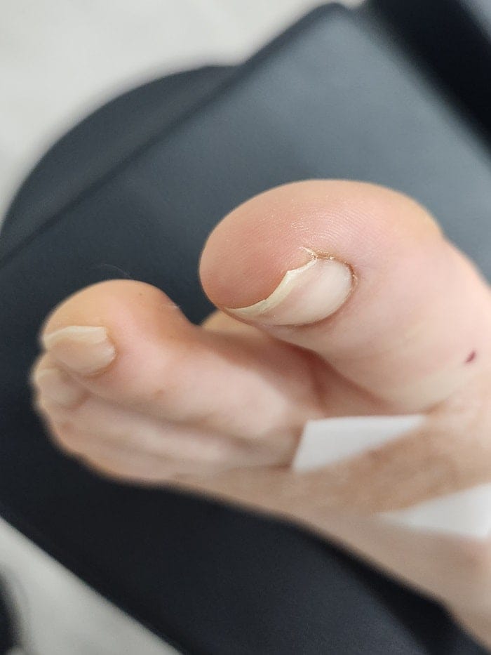 Ingrown Toenail Treatment for Children and Adolescents at Gangnam Standard Orthopedics — 2