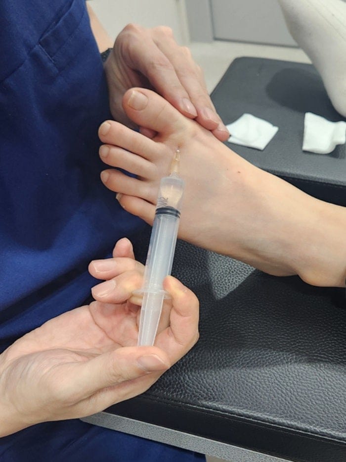 Ingrown Toenail Treatment for Children and Adolescents at Gangnam Standard Orthopedics — 3