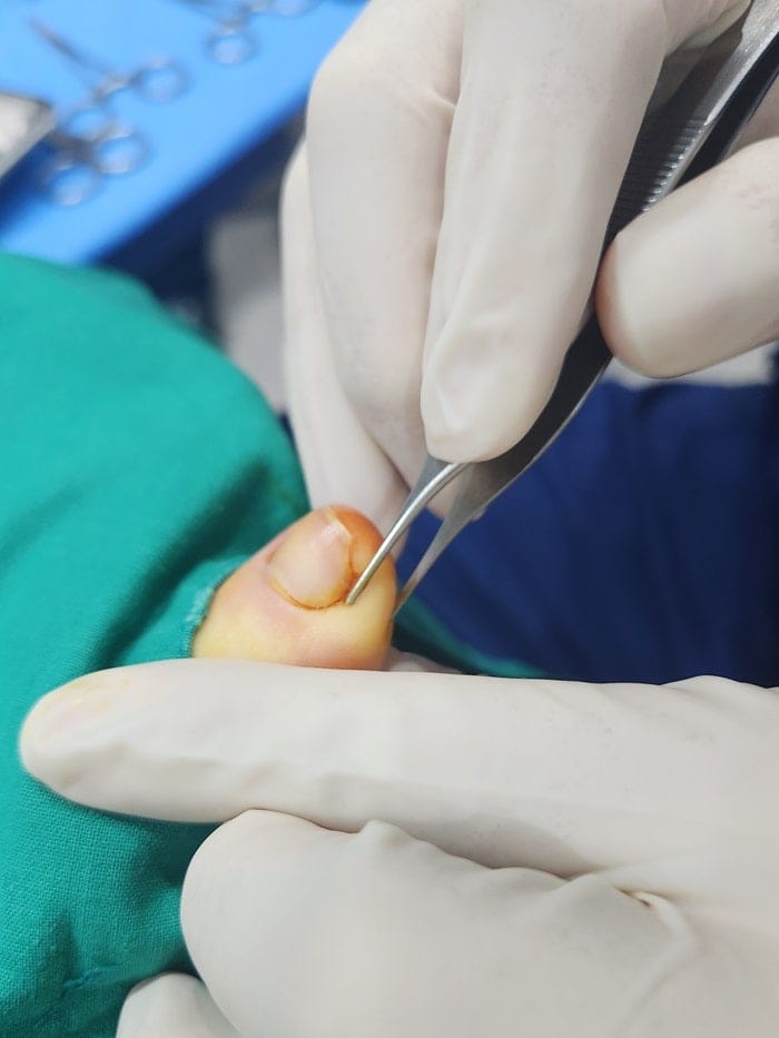 Ingrown Toenail Treatment for Children and Adolescents at Gangnam Standard Orthopedics — 5