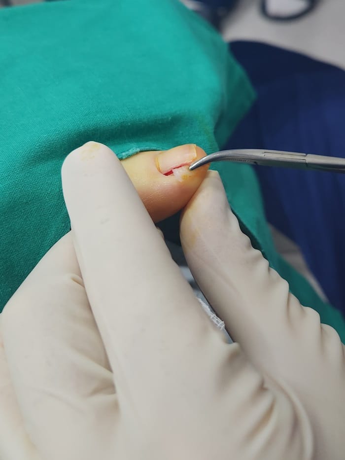 Ingrown Toenail Treatment for Children and Adolescents at Gangnam Standard Orthopedics — 6