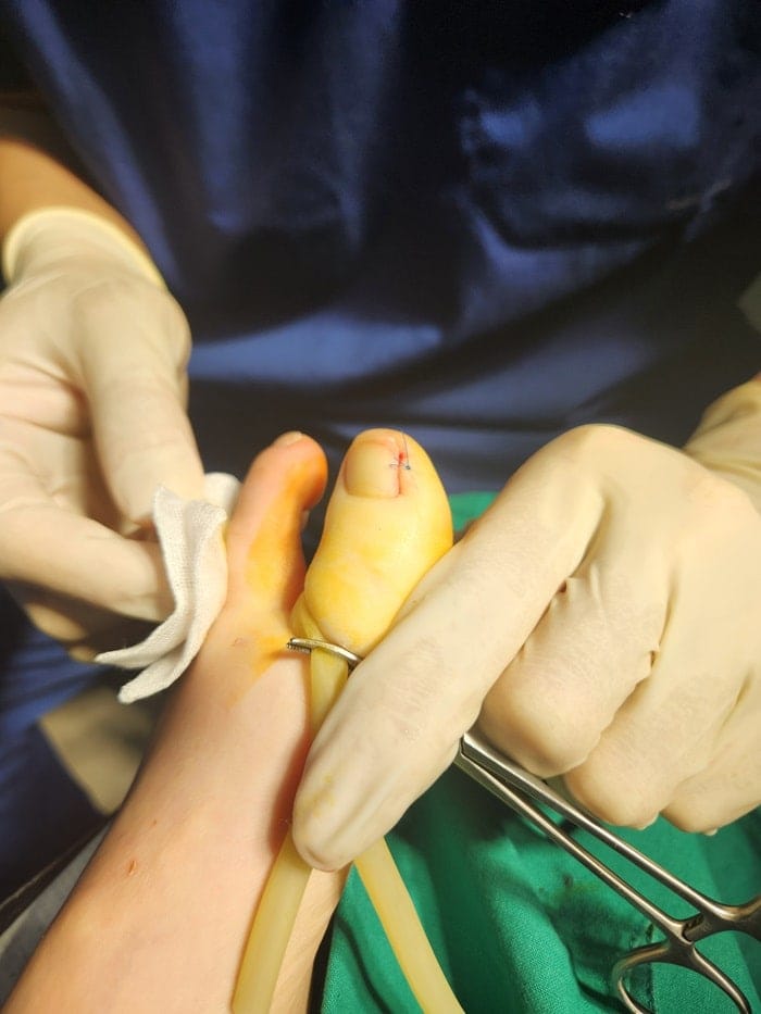 Ingrown Toenail Treatment for Children and Adolescents at Gangnam Standard Orthopedics — 7