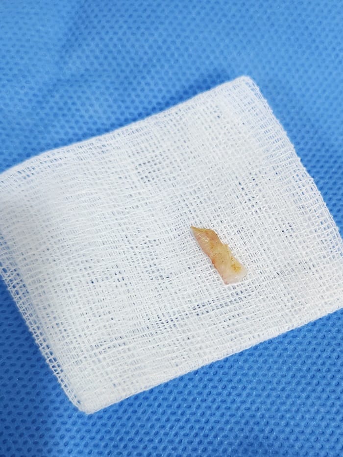 Ingrown Toenail Treatment for Children and Adolescents at Gangnam Standard Orthopedics — 8