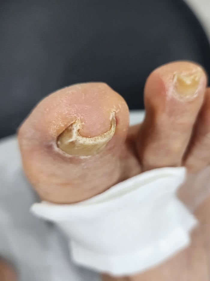Big Toe Pain and Ingrown Toenail: Why You Should See an Ingrown Toenail Specialist — 2