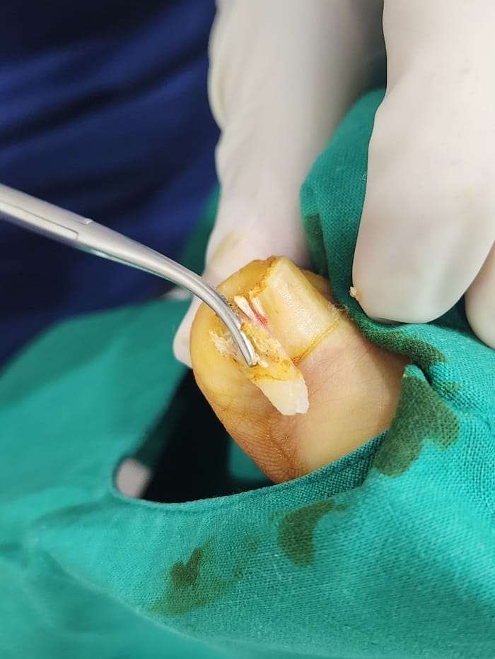 Big Toe Pain and Ingrown Toenail: Why You Should See an Ingrown Toenail Specialist — 4