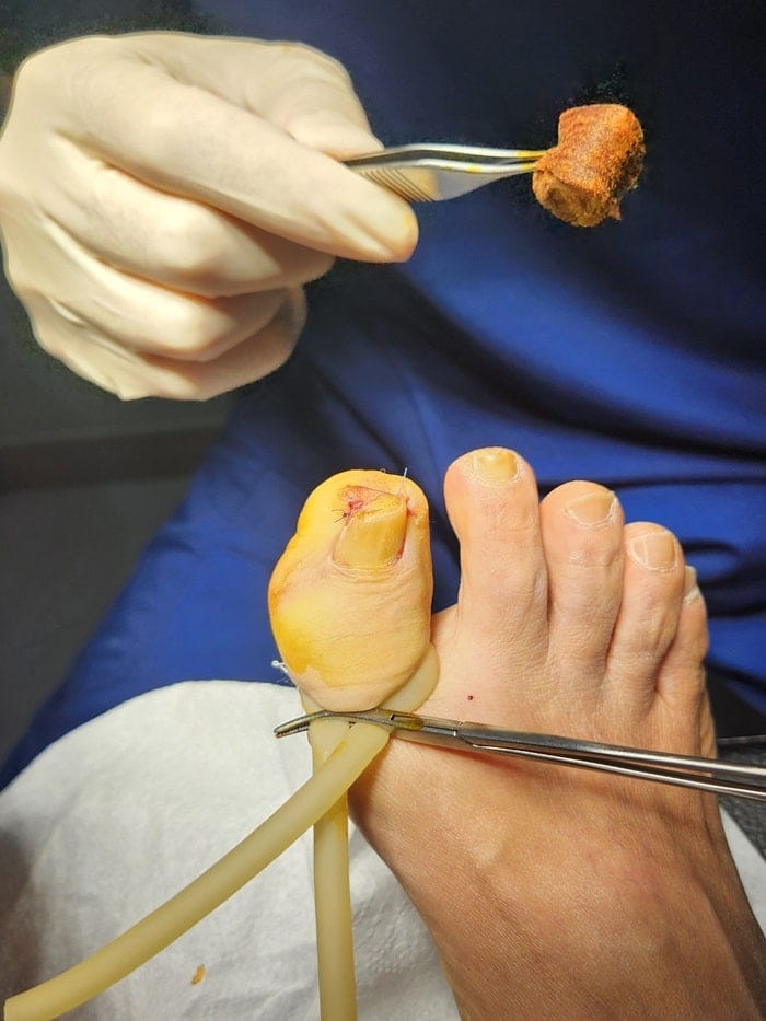 Big Toe Pain and Ingrown Toenail: Why You Should See an Ingrown Toenail Specialist — 5