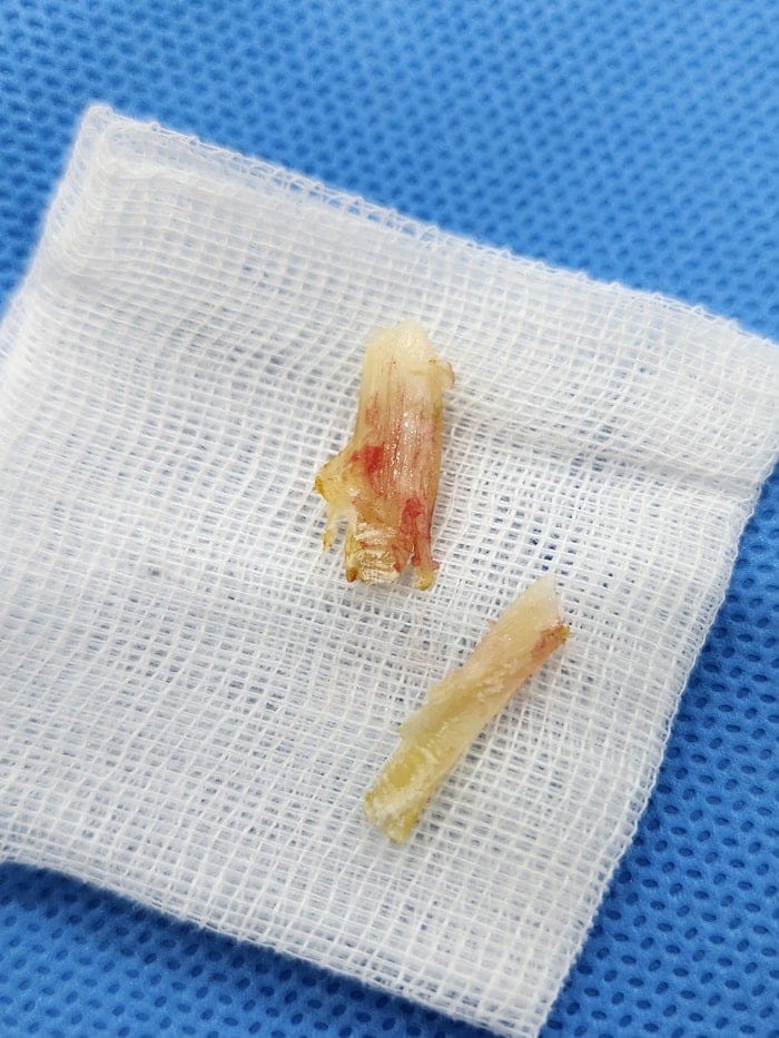 Big Toe Pain and Ingrown Toenail: Why You Should See an Ingrown Toenail Specialist — 6
