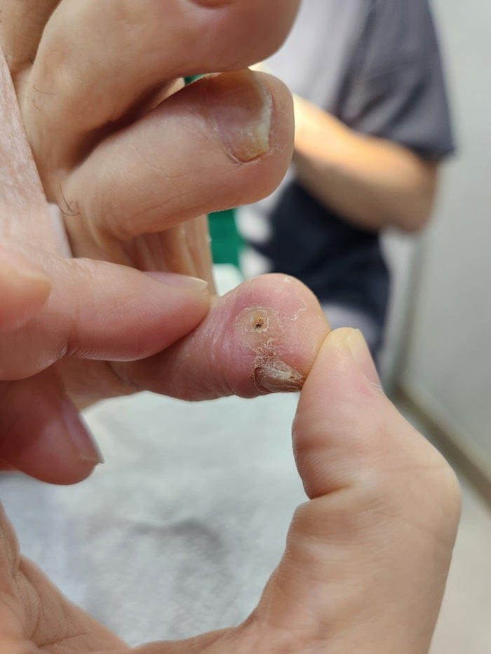 Toe Corns and Calluses on the Little Toe: Treating the Root Cause