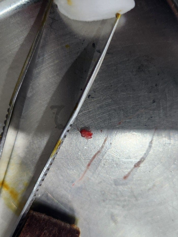 Toe Corns and Calluses on the Little Toe: Treating the Root Cause