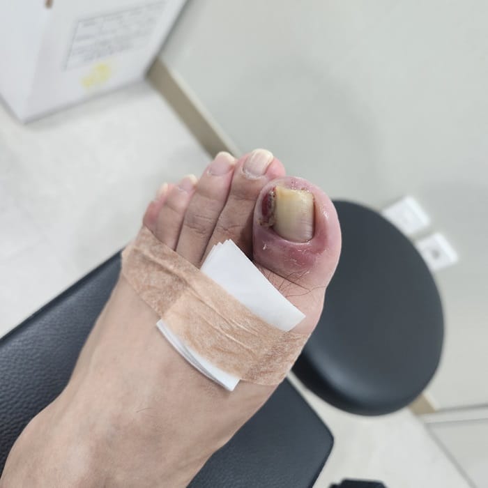 Ingrown Toenail: Causes of Toe Inflammation, Big Toe Pain, and Toenail Pain