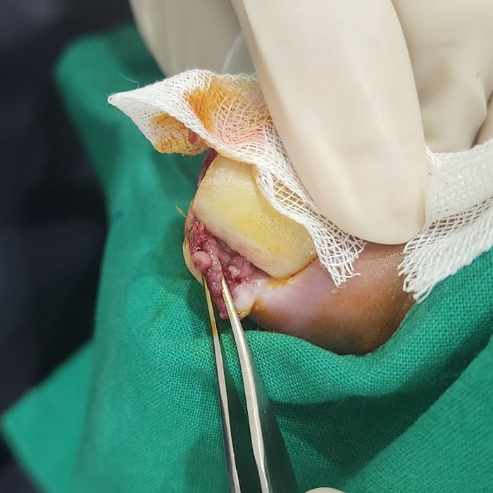 Ingrown Toenail: Causes of Toe Inflammation, Big Toe Pain, and Toenail Pain