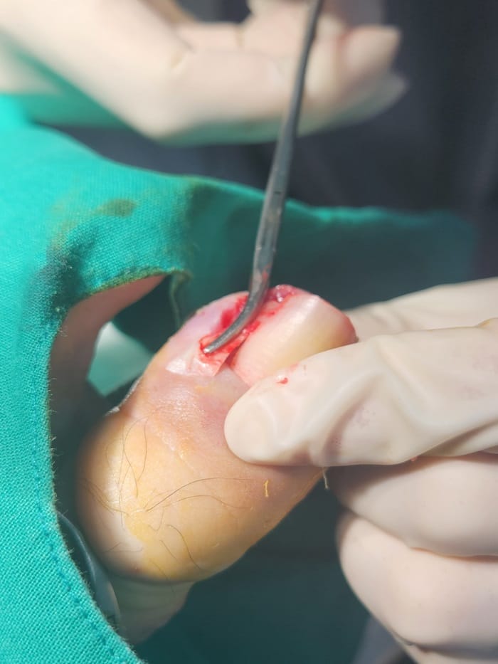 Ingrown Toenail: Causes of Toe Inflammation, Big Toe Pain, and Toenail Pain
