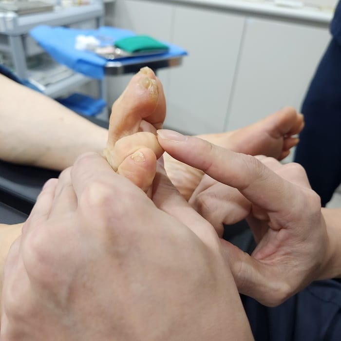 Corn Removal Surgery for Toe Corns and Hammer Toe — Same-Day Procedure After 3 Years of Dermatology Visits