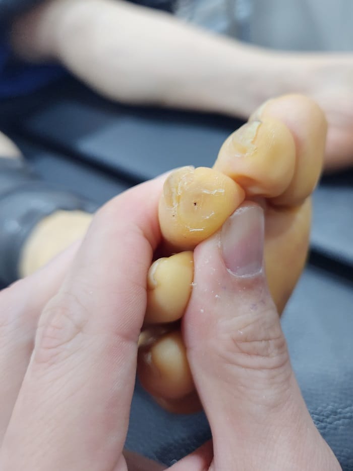 Corn Removal Surgery for Toe Corns and Hammer Toe — Same-Day Procedure After 3 Years of Dermatology Visits
