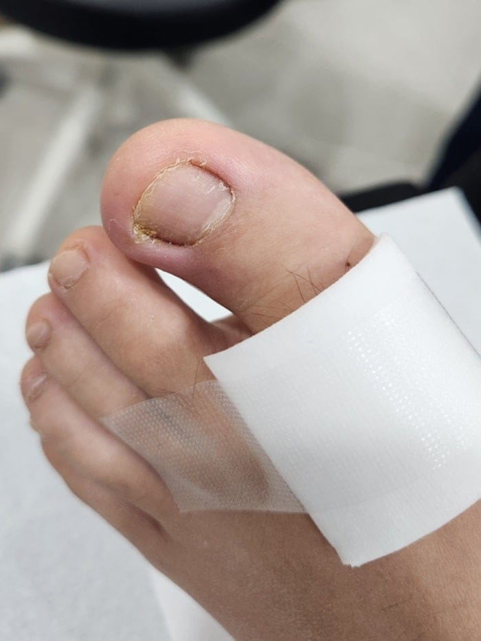 Ingrown Toenail in Children: Pus, Inflammation, and Nail Deformity — What Parents Should Know