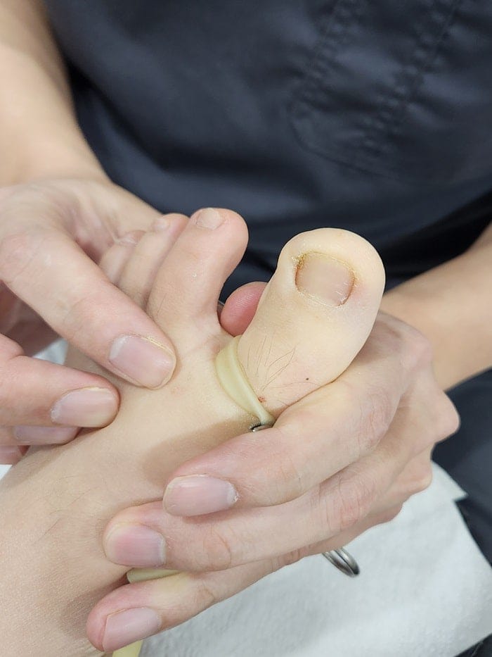 Ingrown Toenail in Children: Pus, Inflammation, and Nail Deformity — What Parents Should Know — 2