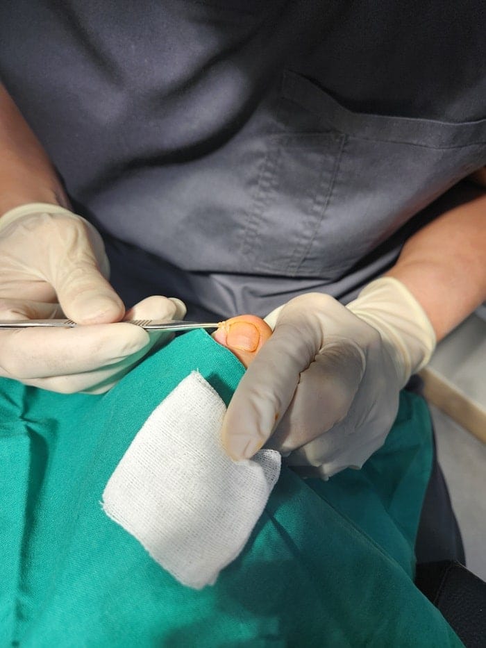 Ingrown Toenail in Children: Pus, Inflammation, and Nail Deformity — What Parents Should Know — 3