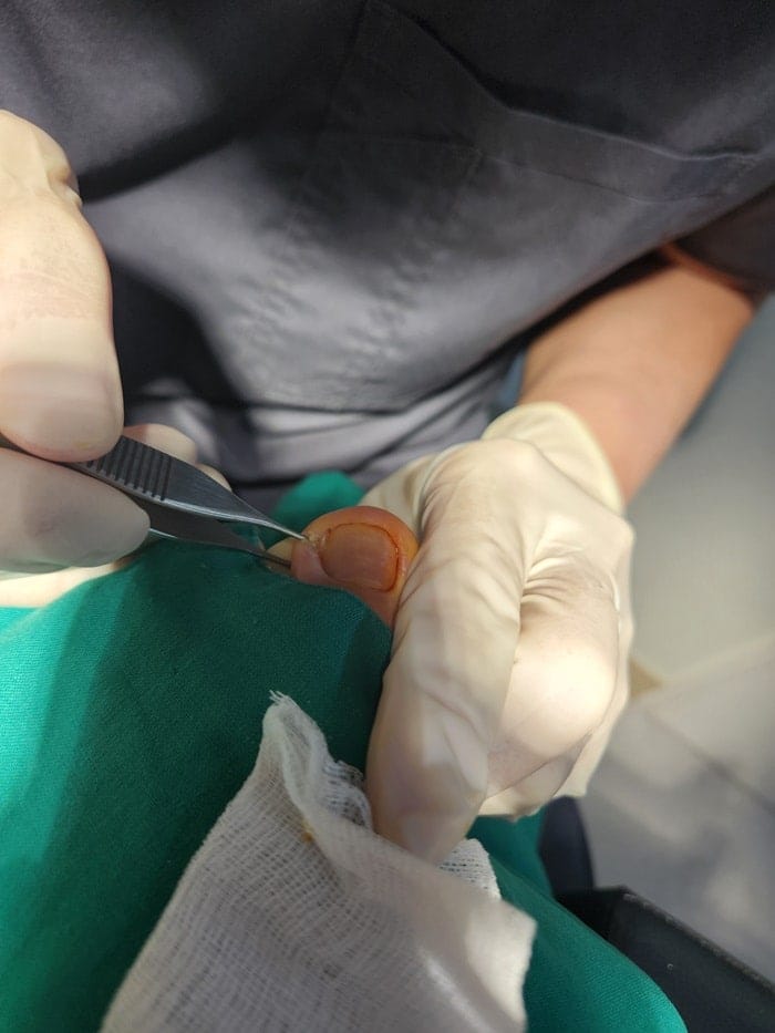 Ingrown Toenail in Children: Pus, Inflammation, and Nail Deformity — What Parents Should Know — 4