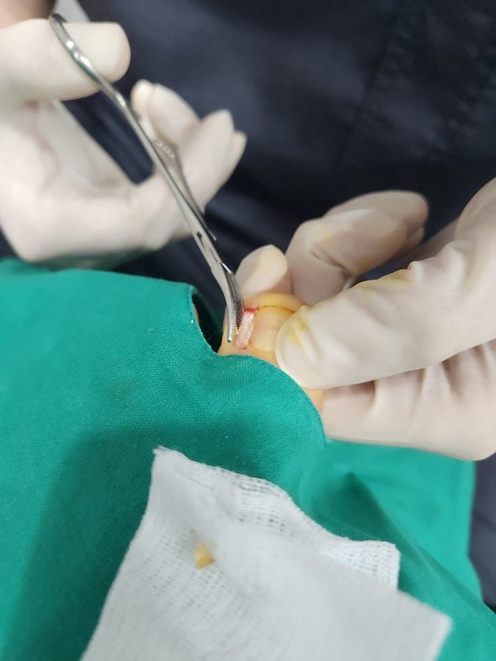 Ingrown Toenail in Children: Pus, Inflammation, and Nail Deformity — What Parents Should Know — 5