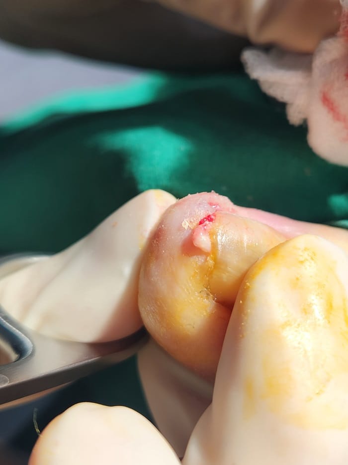 Ingrown Toenail Treatment in Gangnam: Pus, Inflammation, and Nail Deformity Treated Accurately — 2