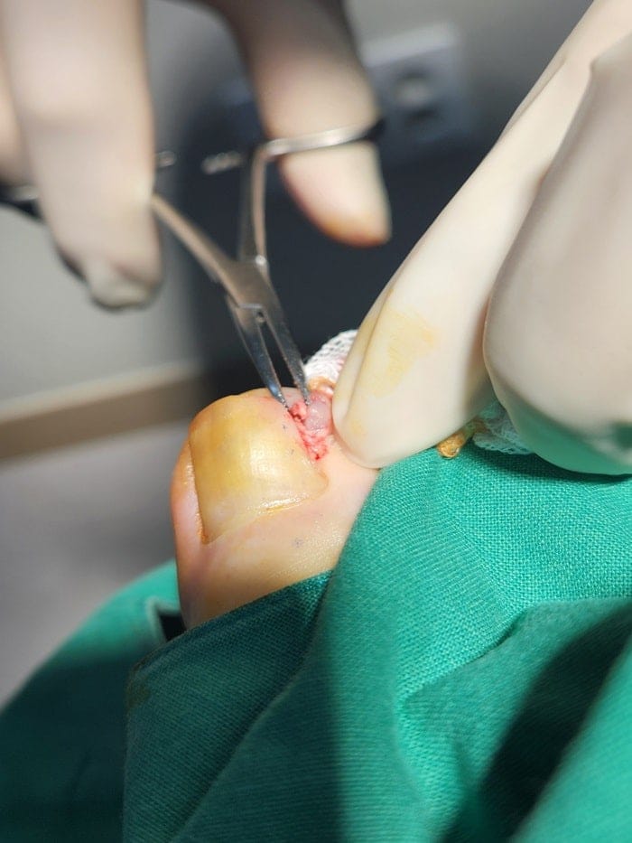 Ingrown Toenail Treatment in Gangnam: Pus, Inflammation, and Nail Deformity Treated Accurately — 3