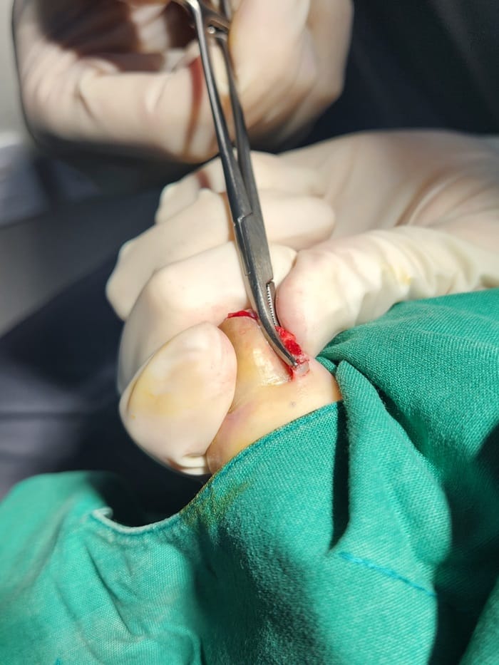 Ingrown Toenail Treatment in Gangnam: Pus, Inflammation, and Nail Deformity Treated Accurately — 4