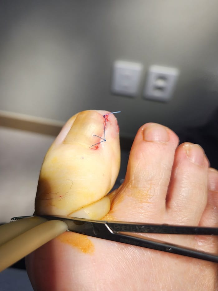Ingrown Toenail Treatment in Gangnam: Pus, Inflammation, and Nail Deformity Treated Accurately — 5