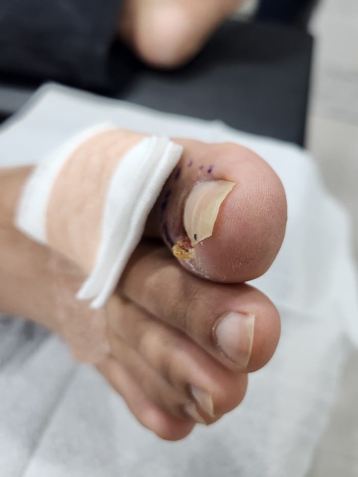 Ingrown Toenail Treatment in Gangnam: Inflammation, Discharge, and Nail Deformity All Addressed — 2