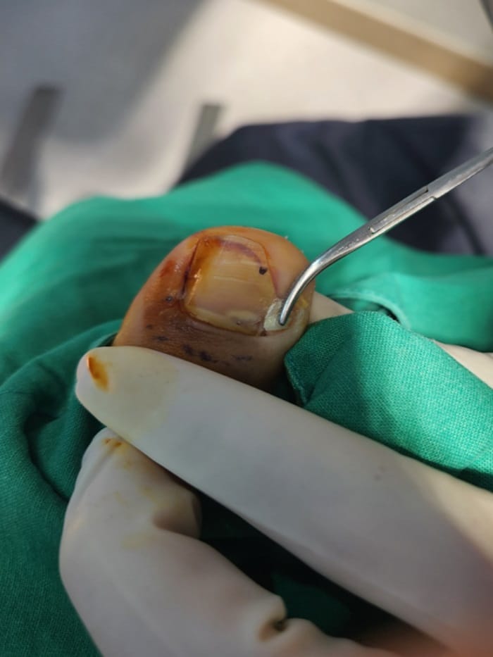 Ingrown Toenail Treatment in Gangnam: Inflammation, Discharge, and Nail Deformity All Addressed — 3