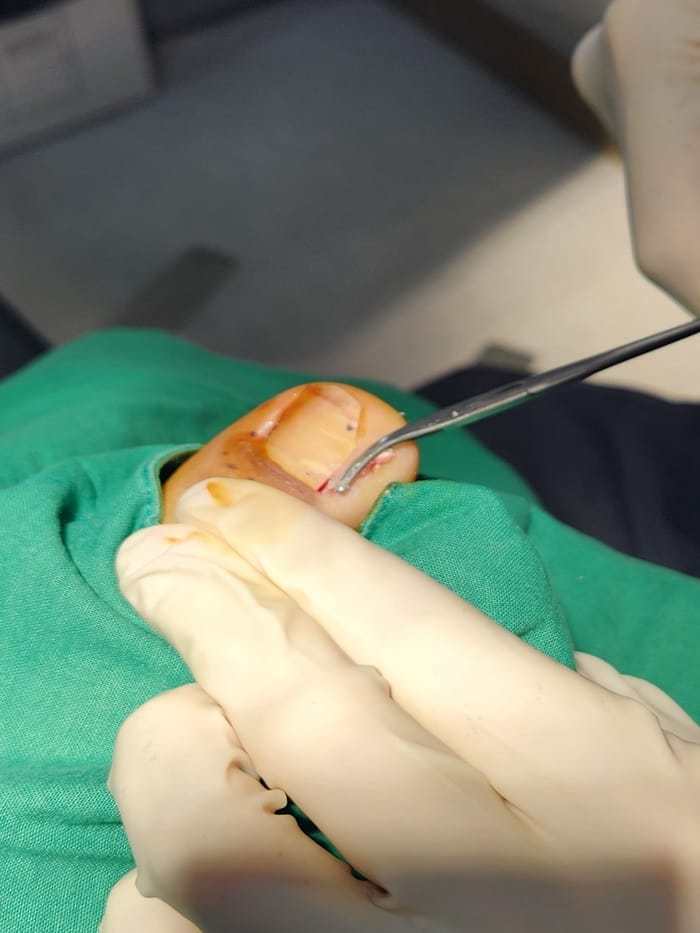 Ingrown Toenail Treatment in Gangnam: Inflammation, Discharge, and Nail Deformity All Addressed — 4