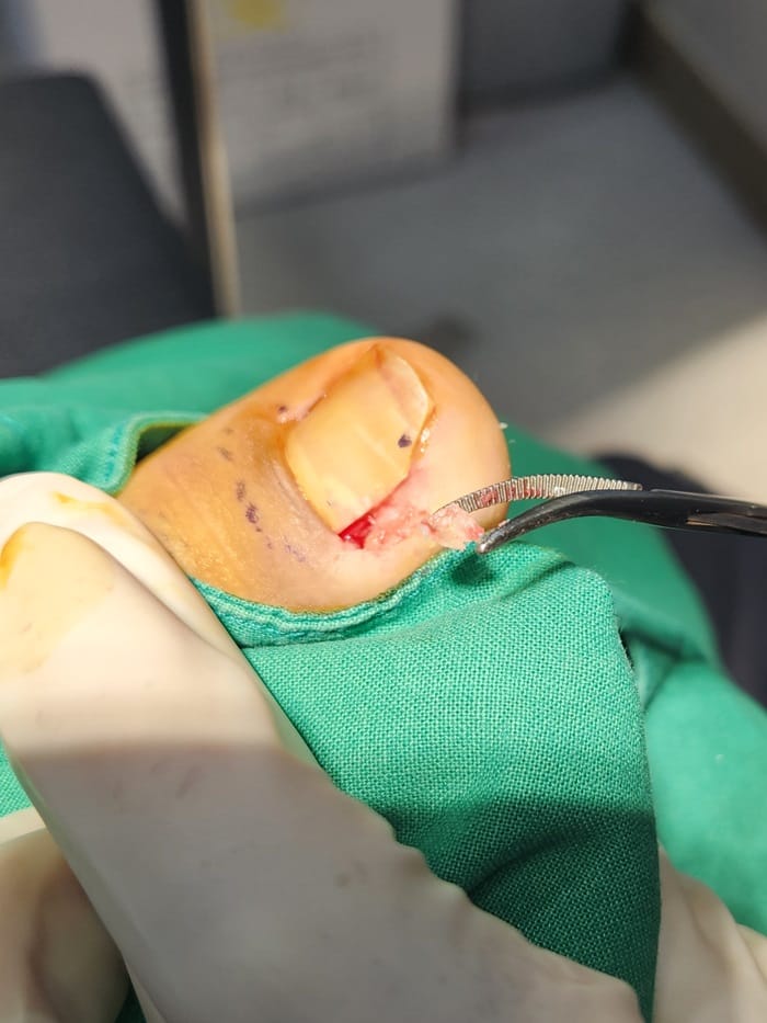 Ingrown Toenail Treatment in Gangnam: Inflammation, Discharge, and Nail Deformity All Addressed — 5