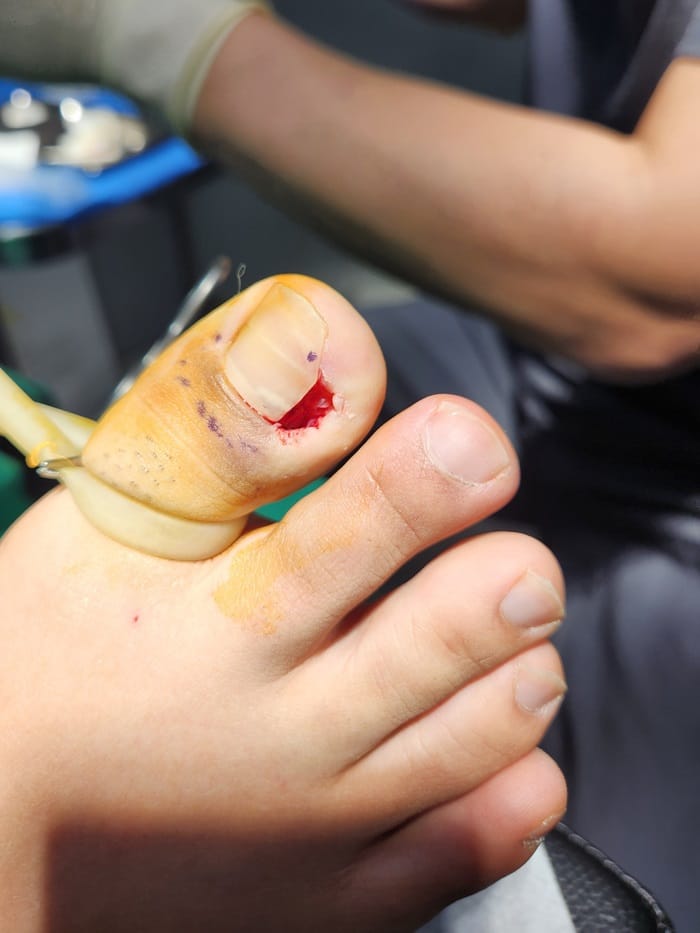 Ingrown Toenail Treatment in Gangnam: Inflammation, Discharge, and Nail Deformity All Addressed — 6