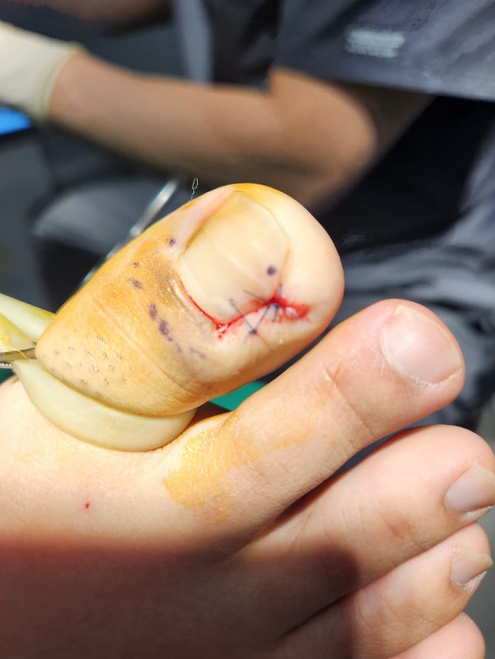 Ingrown Toenail Treatment in Gangnam: Inflammation, Discharge, and Nail Deformity All Addressed — 7