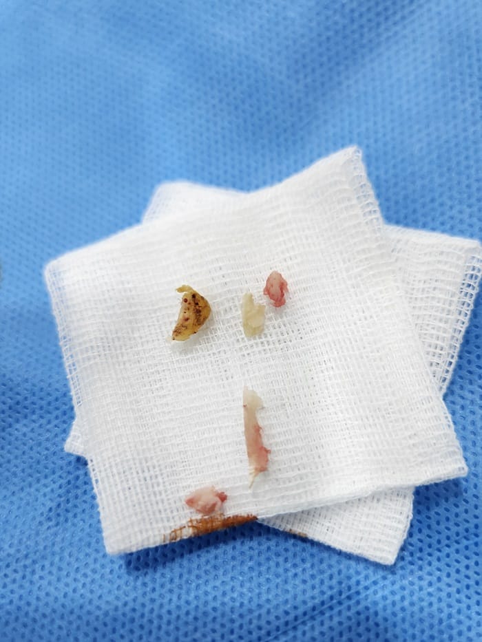 Ingrown Toenail Treatment in Gangnam: Inflammation, Discharge, and Nail Deformity All Addressed — 8