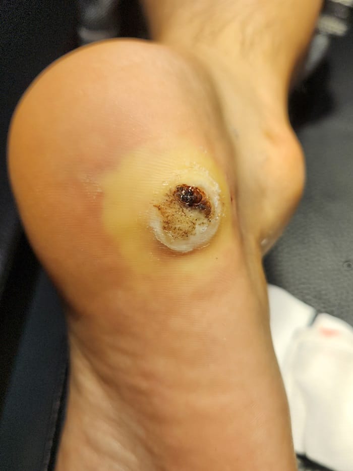 Plantar Corns, Calluses, and Warts: Why You Should See a Foot Specialist — 2