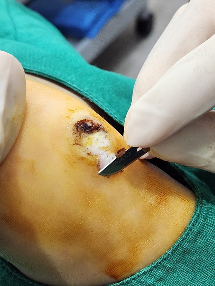 Plantar Corns, Calluses, and Warts: Why You Should See a Foot Specialist — 3