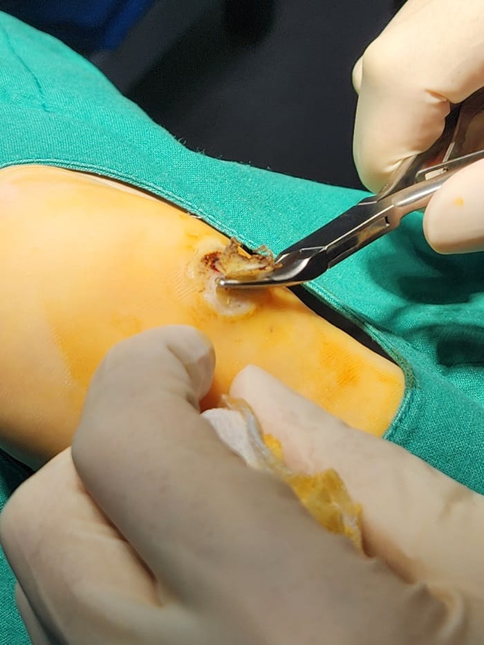 Plantar Corns, Calluses, and Warts: Why You Should See a Foot Specialist — 4